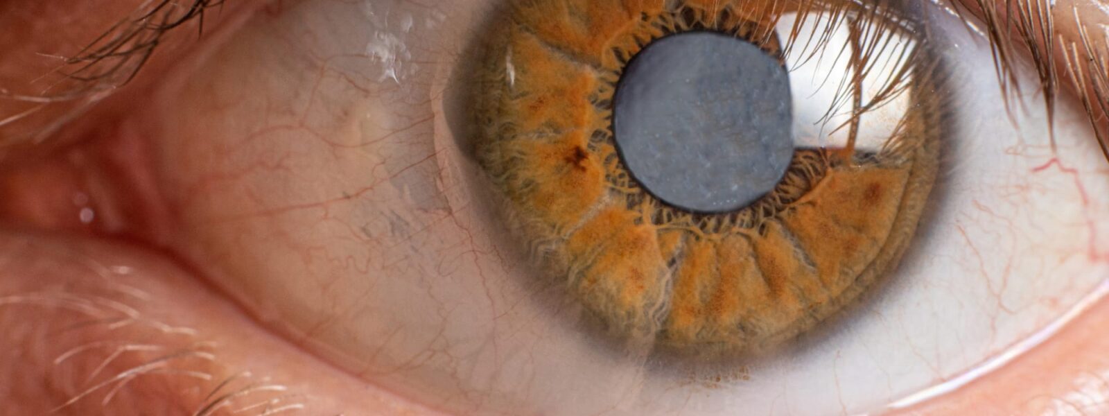 Der Graue Star wird im menschlichen Auge dargestellt. Das Innere der Pupille ist grau