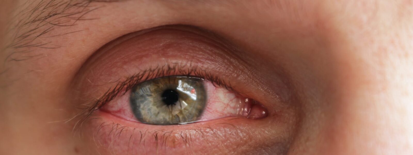 Das Bild zeigt ein Auge mit der Krankheit grüner Star in Nahaufnahme