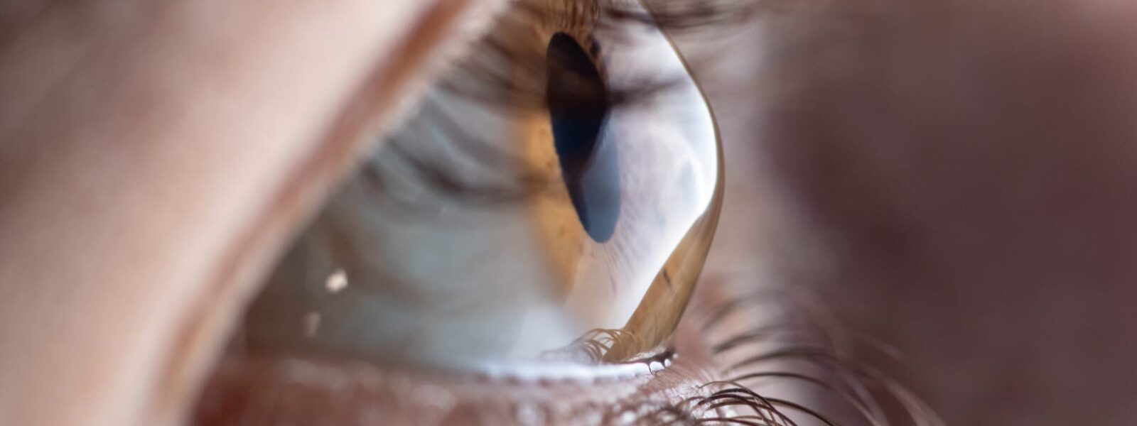 Ein Auge mit der Keratokonus-Erkrankung