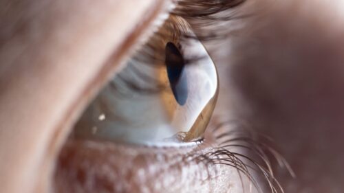Ein Auge mit der Keratokonus-Erkrankung